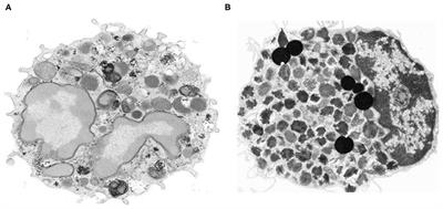 Is There a Role for Basophils in Cancer?